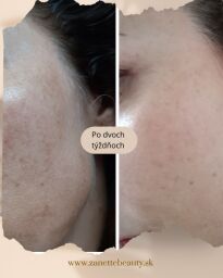 Pigmentácia zo slniečka